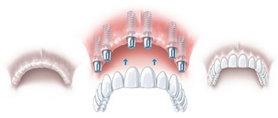 Комплексная крестальная имплантация зубов